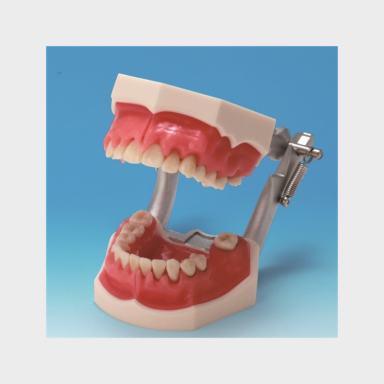 Parodontitis Studiemodel med Aftageligt Gingiva 